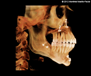 Marie-Hélène Cyr - 3D scan (right profile) after orthodontic treatments and orthognathic surgeries (February 13, 2012)